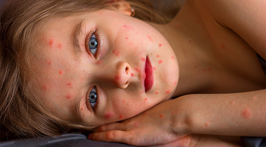 Red rash on the skin of a little girl, chicken pox and measles in children on the face close-up